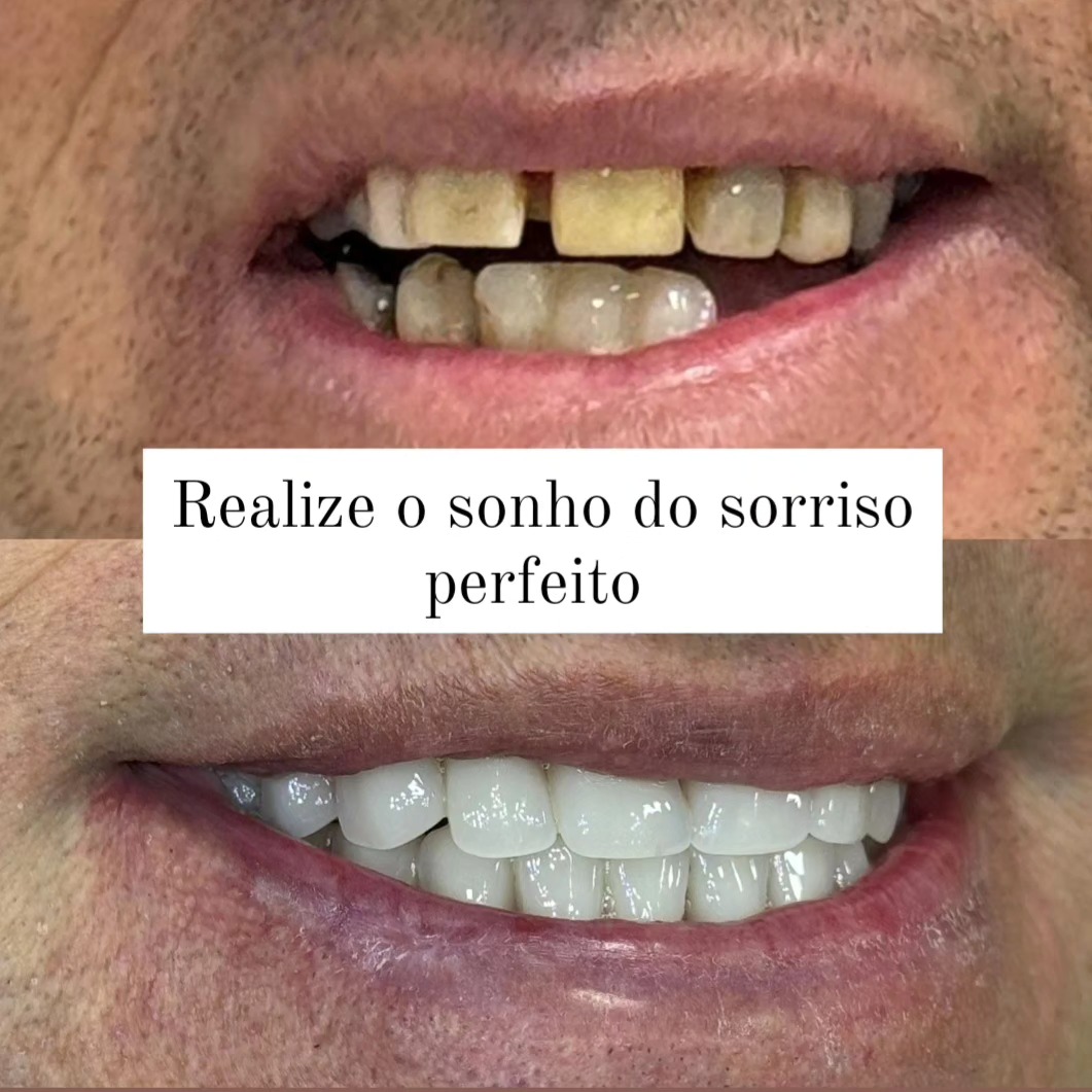 Harmonização Orofacial (antes e depois)